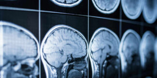 Close-up of MRI brain scans displayed on a screen
