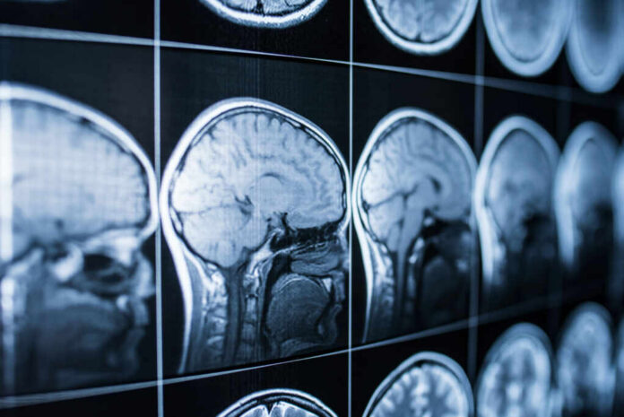 Close-up of MRI brain scans displayed on a screen