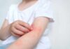 Sunscreen Rankings Hide One Inconvenient Truth Child's arm showing skin irritation and redness