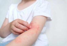 Sunscreen Rankings Hide One Inconvenient Truth Child's arm showing skin irritation and redness